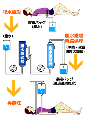 腹水濾過濃縮再静注法(CART)