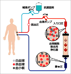 白血球除去療法（LCAP）