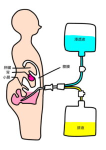 腹膜透析のしくみ