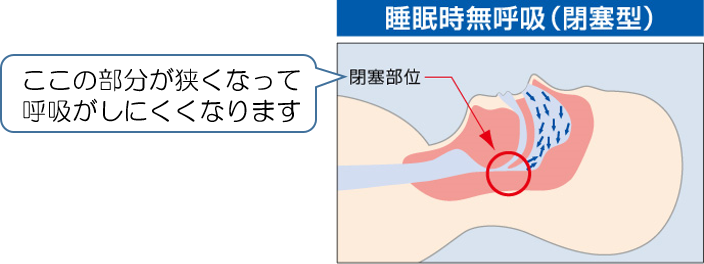 気道の閉塞型