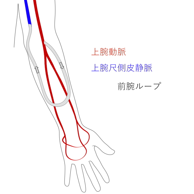 上腕動脈表在化法