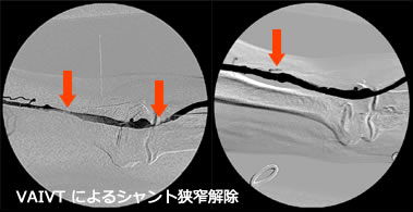 シャント狭窄解除